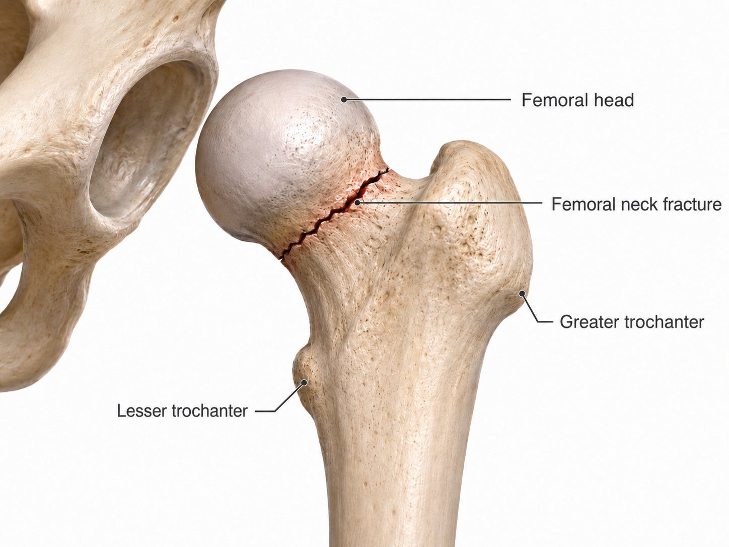 Femoral neck fracture anatomy