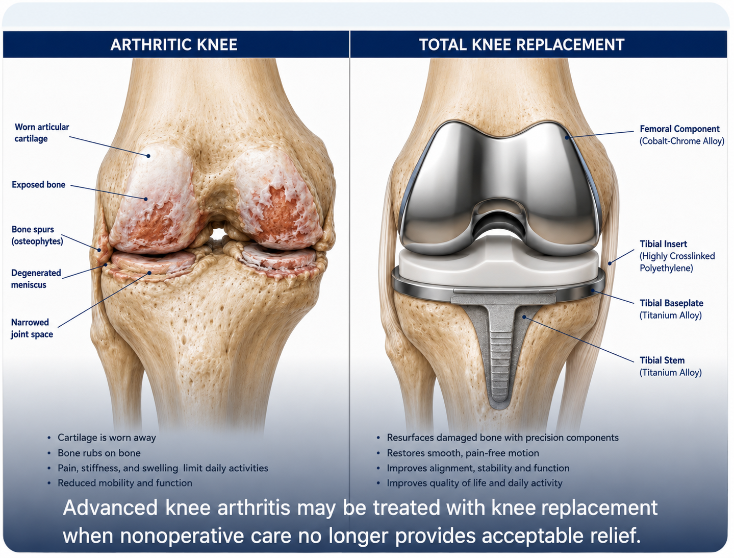 Arthritic knee compared with total knee replacement components